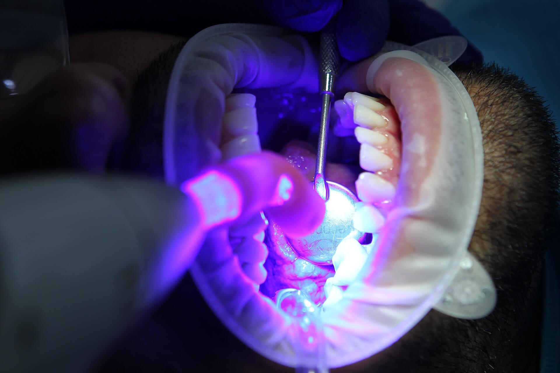 laser-dental-treatment-in-sivagangai